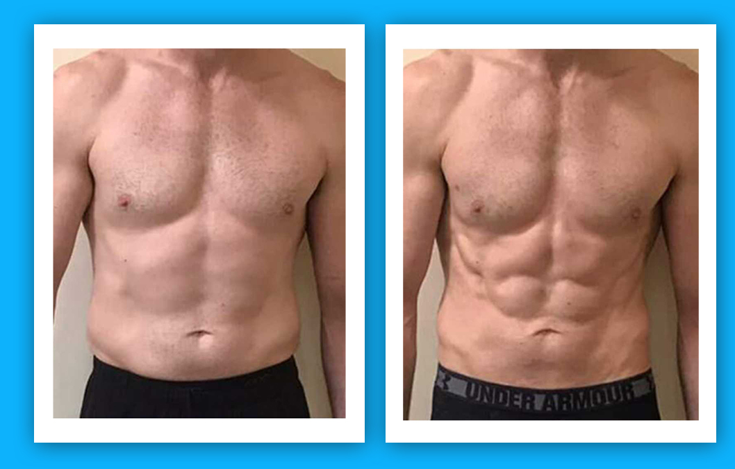 EMS + RF - Body Contouring - Package (2 Areas)