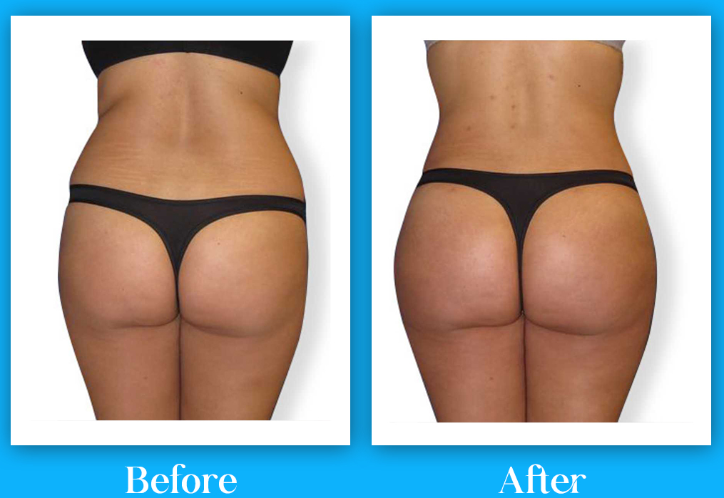 EMS + RF  - Body Contouring - 8 Session Package